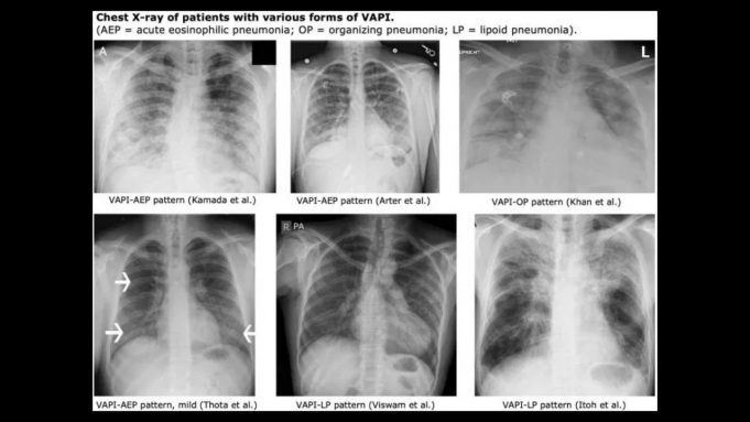 lung XRays of VAPI patients